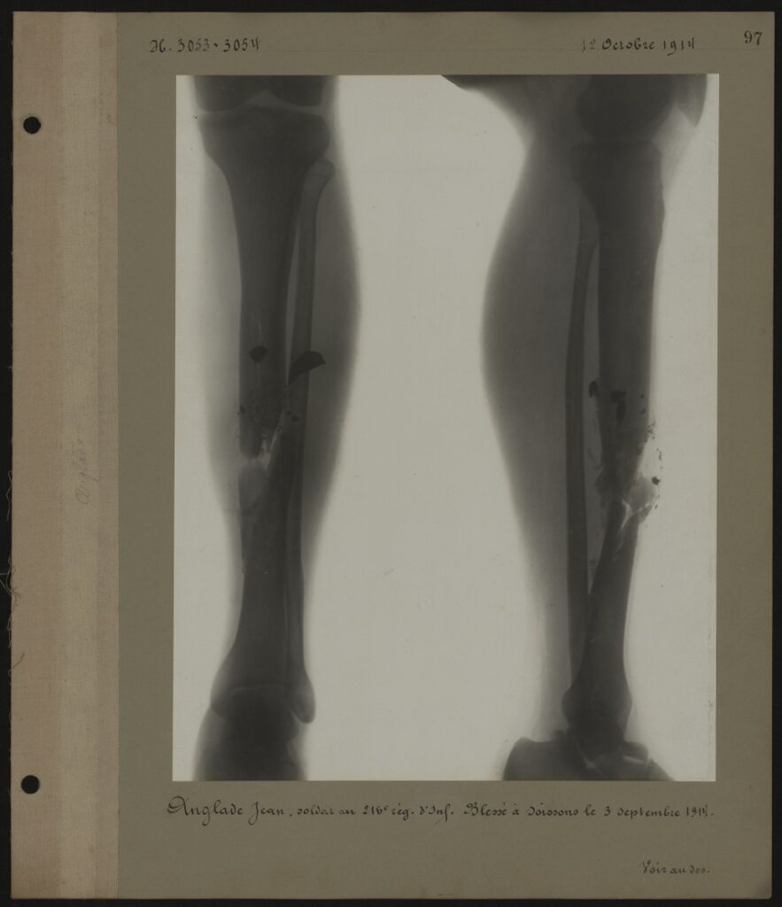 Radio des jambes d'un poilu